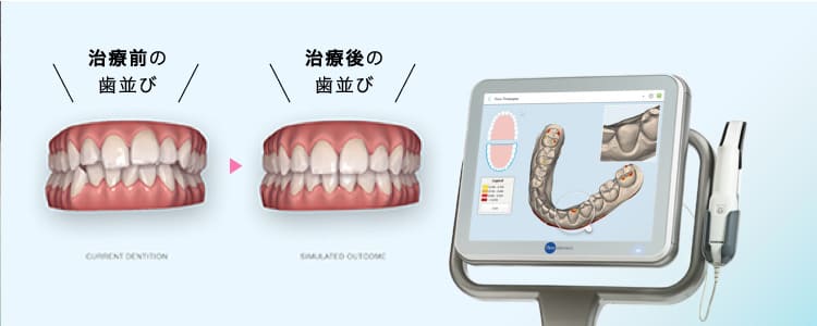 短時間で精密なスキャンデータ所得