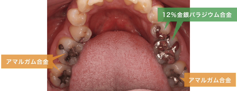 アマルガム合金・12%金銀パラジウム合金