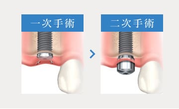 一次手術・二次手術