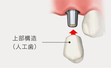 人工歯