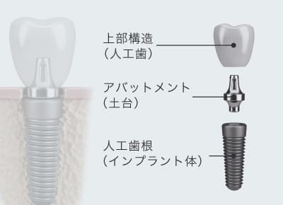 人工歯・土台・人工歯根