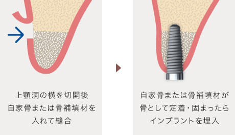 上顎洞の横を切開後、自家骨または骨補填材を入れて縫合 → 自家骨または骨補填材が骨として定着・固まったらインプラントを埋入