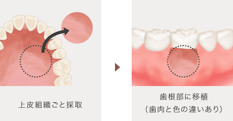 上皮組織ごと採取 → 歯根部に移植（歯肉と色の違いあり）